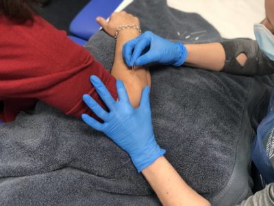 Acupuncture