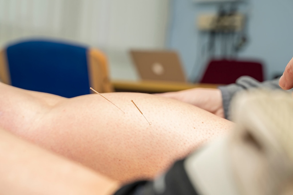 Acupuncture Therapy Berkhamsted
