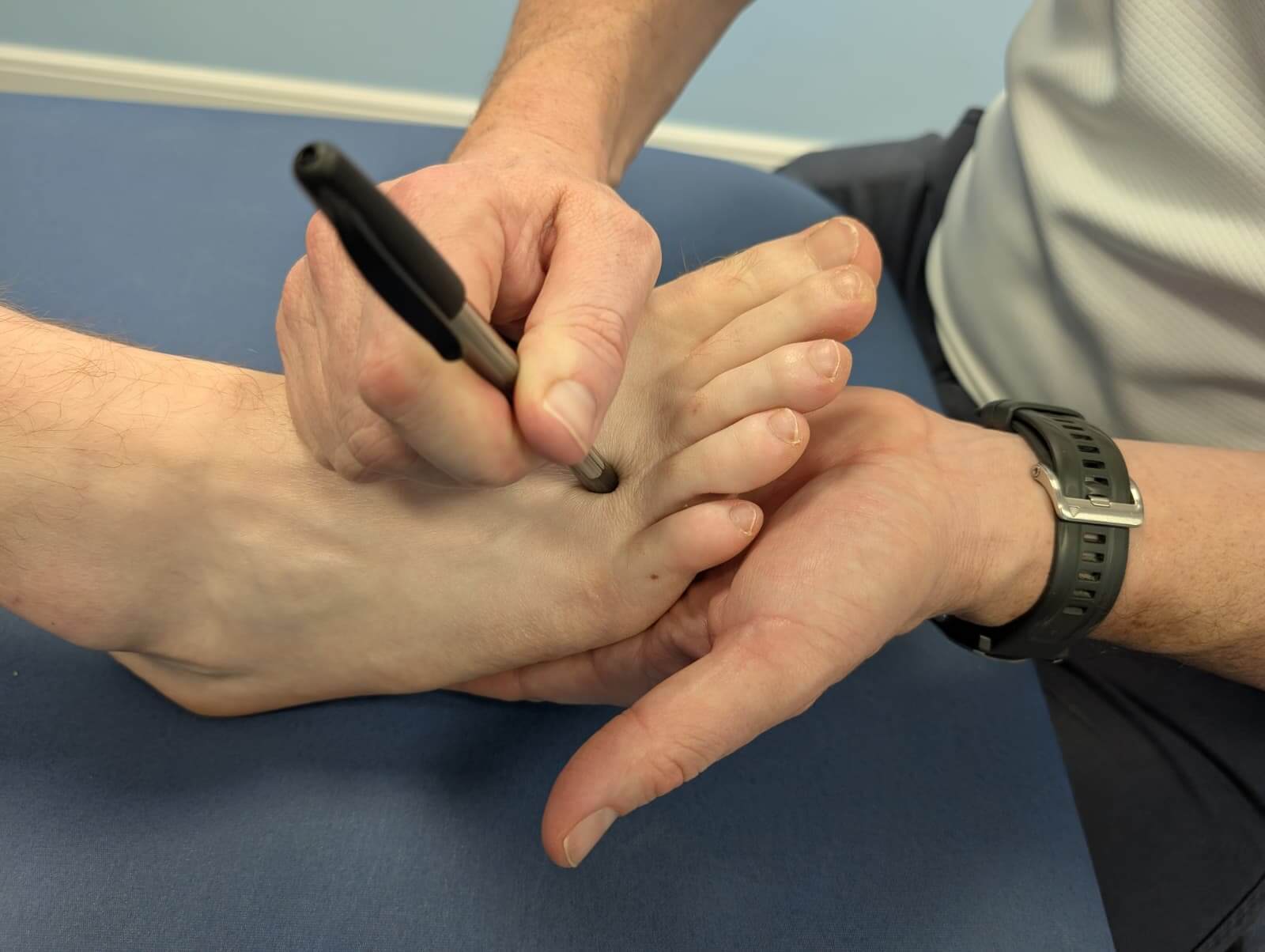 Physio Common Conditions Morton's Neuroma